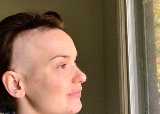 Close-up of white woman's head, with brown hair. The side of her head above ear shows scalp, no hair.
