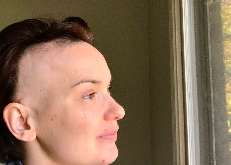 Close-up of white woman's head, with brown hair. The side of her head above ear shows scalp, no hair.